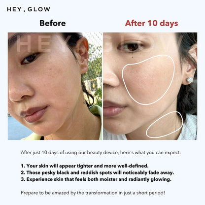 Anti Aging Facial Treatment Device