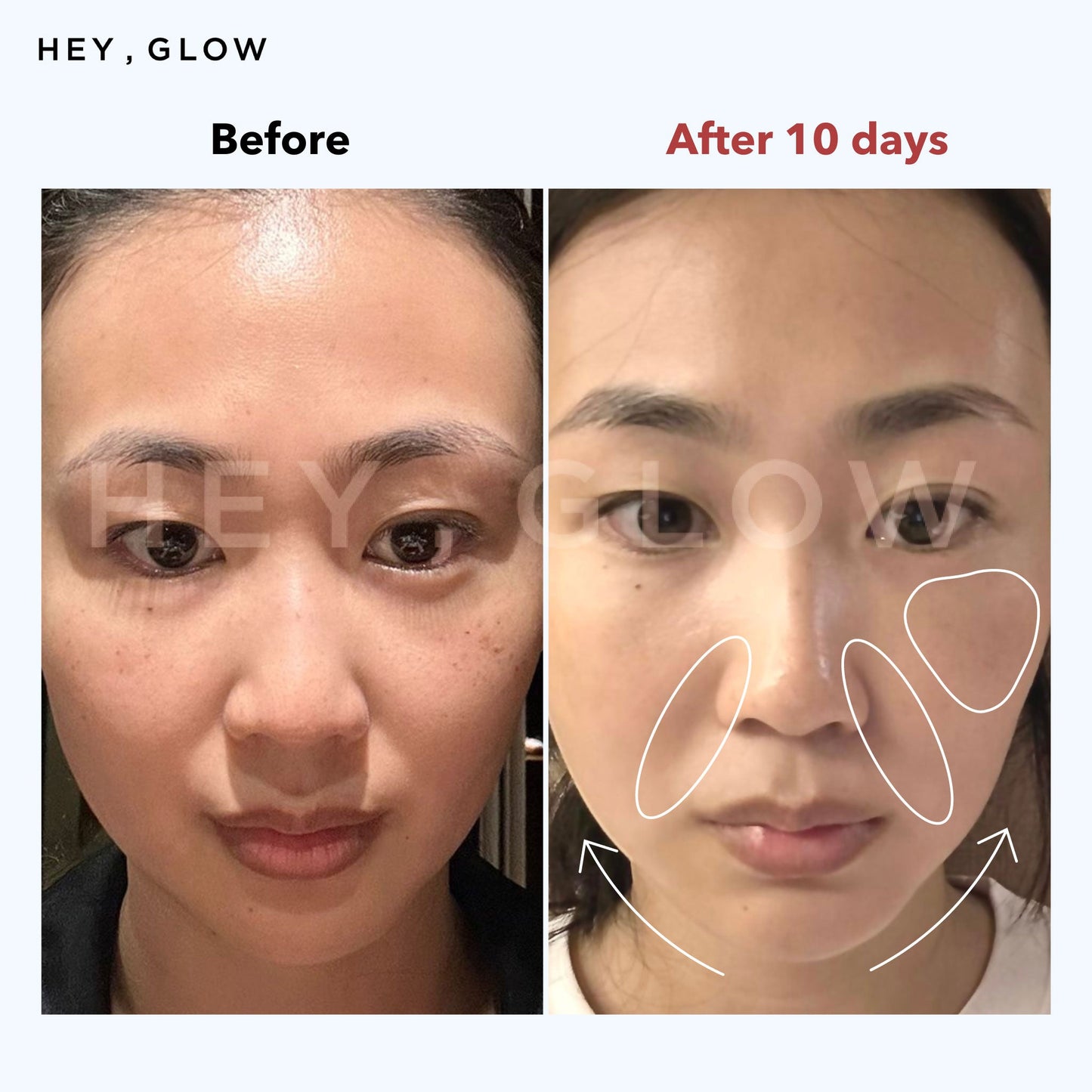 Anti Aging Facial Treatment Device